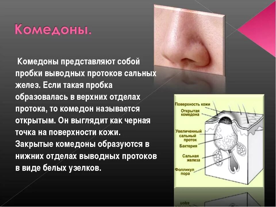 Запах железа носу железы. Сальные железы представляют собой. Комедоны причины возникновения. Сальные железы кожи на носу.