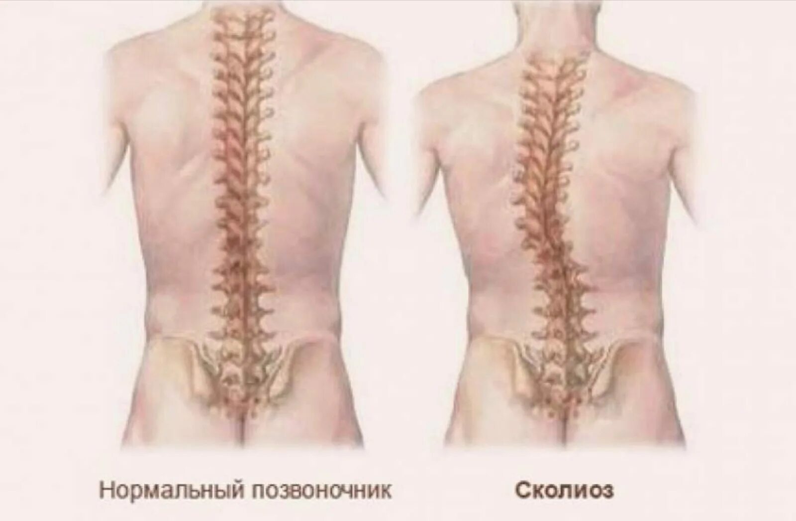 Лечение деформации позвоночника