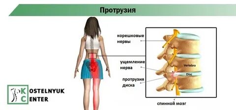 Протрузия что это такое простыми словами лечение
