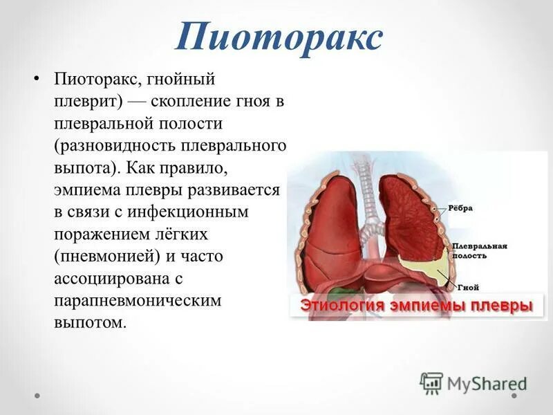 Эмпиема латынь