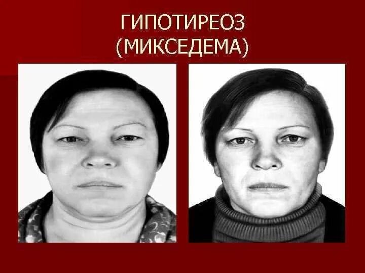 Гипотиреоз симптомы микседема. Периорбитальный отек гипотиреоз.