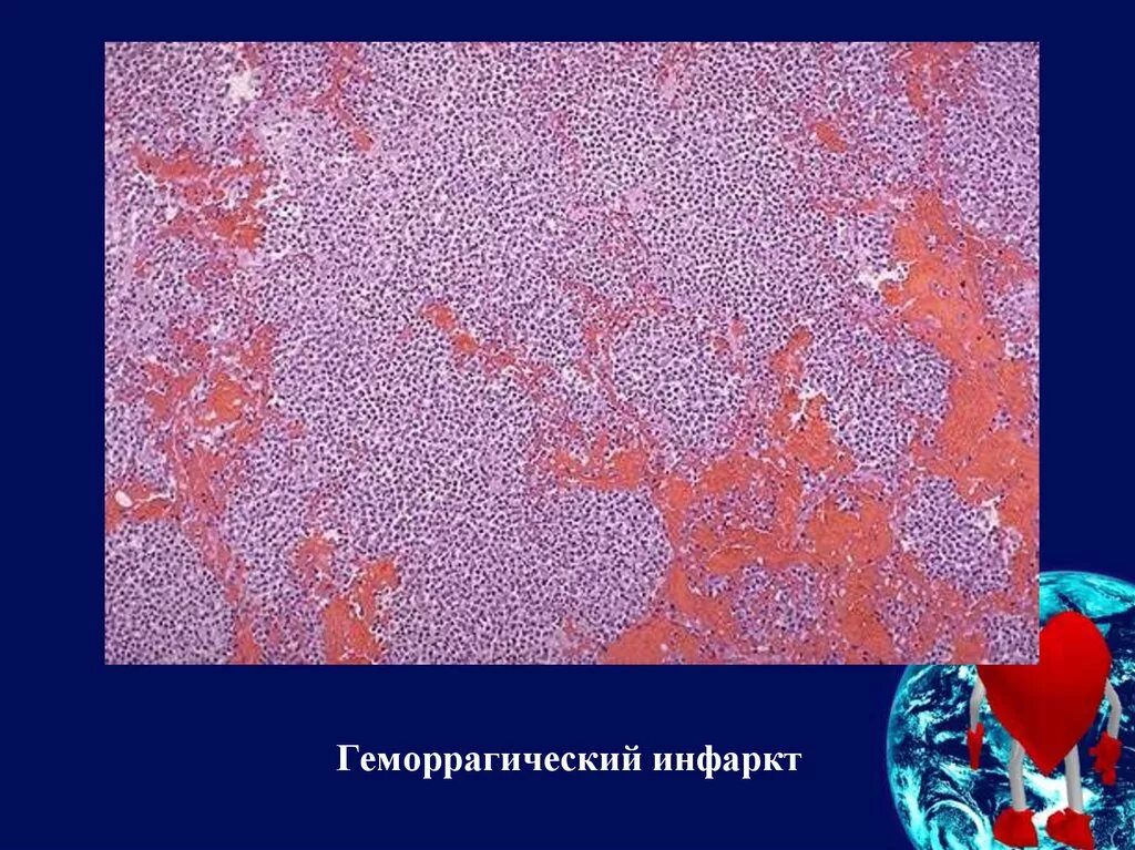 Инфаркт миокарда патологическая анатомия макропрепарат. Геморрагический инфаркт легкого макропрепарат. Геморрагический инфаркт легкого микропрепарат. Геморрагический инфаркт легкого микропрепарат. Геморрагический инфаркт головного мозга патанатомия.