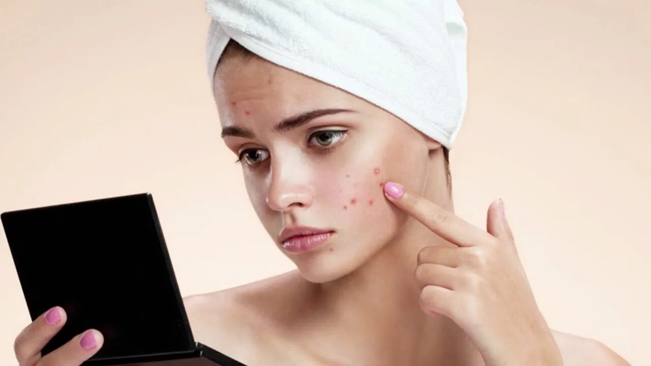 Acne pimple
