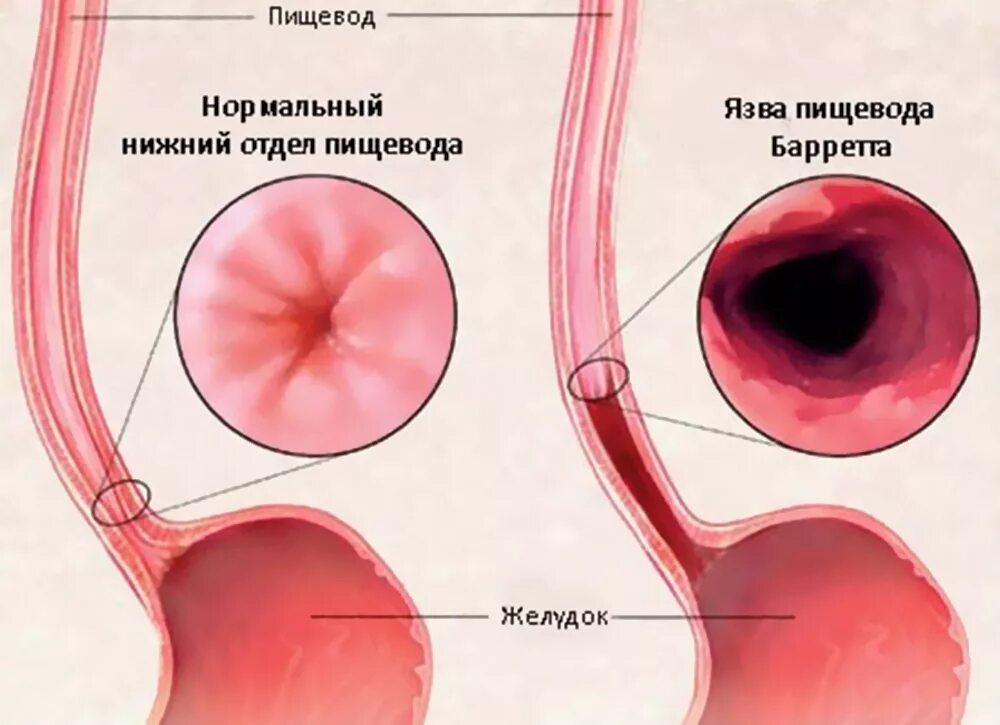 Пищевода лечится