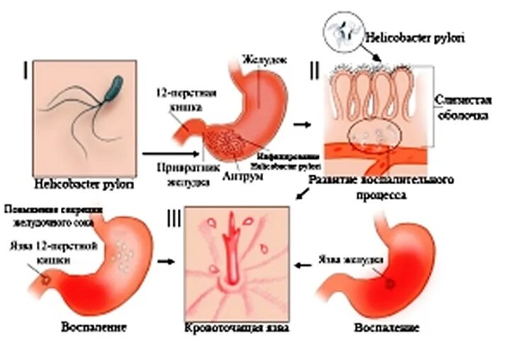 Хеликобактер язык. Хеликобактер пилори сыпь. Норма хеликобактер пилори в желудке. Хеликобактер пилори размер.