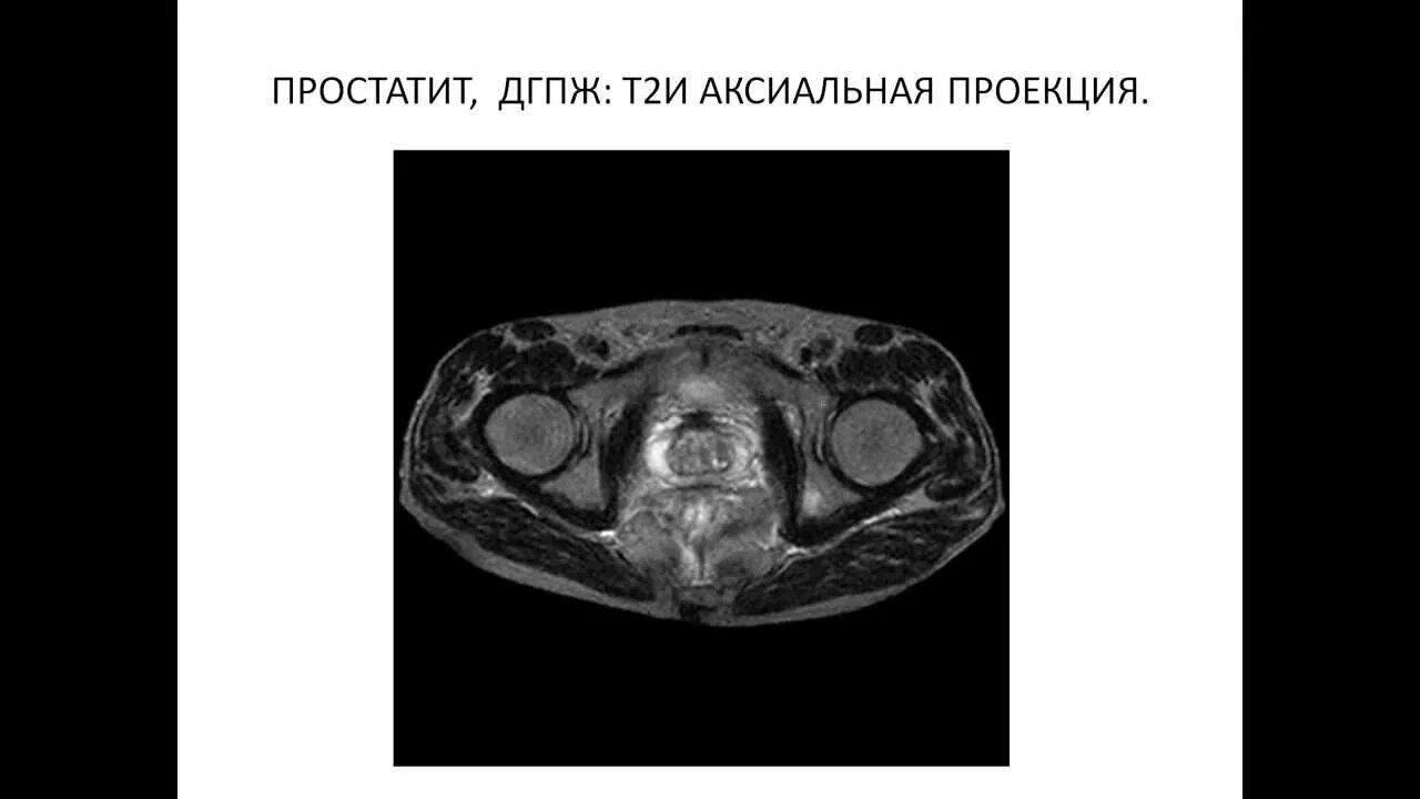 Аденома простаты мрт. Предстательная железа на кт.