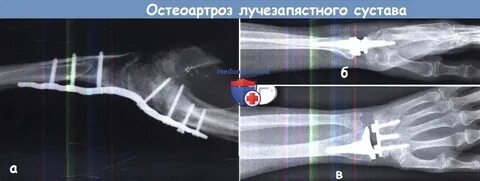 Остеоартроз лучезапястного сустава