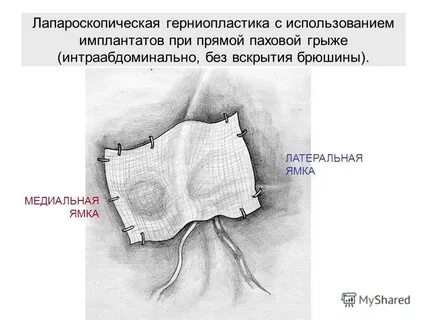 Как делается операция паховая грыжа