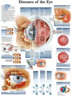 What’s the Difference Between a Meibomian Cyst and a Stye?