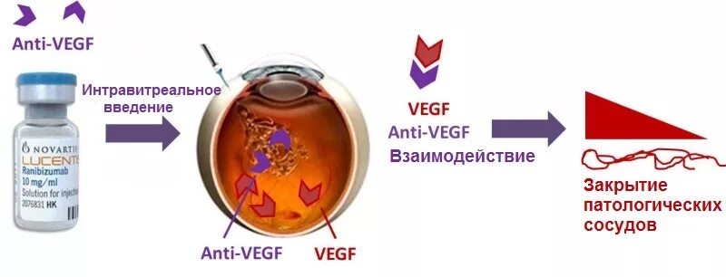 Интравитреальная инъекция. Ингибиторы VEGF препараты. Анти VEGF терапия препараты. Луцентис ранибизумаб.