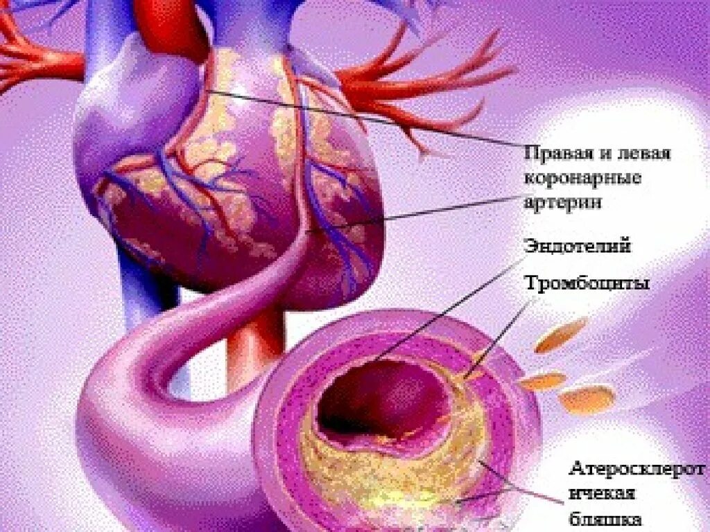 Атеросклероз аорты сосудов сердца. Атеросклероз венечных артерий. атеросклероз венечных артерий сердца. атеросклероз коронарных сосудов.