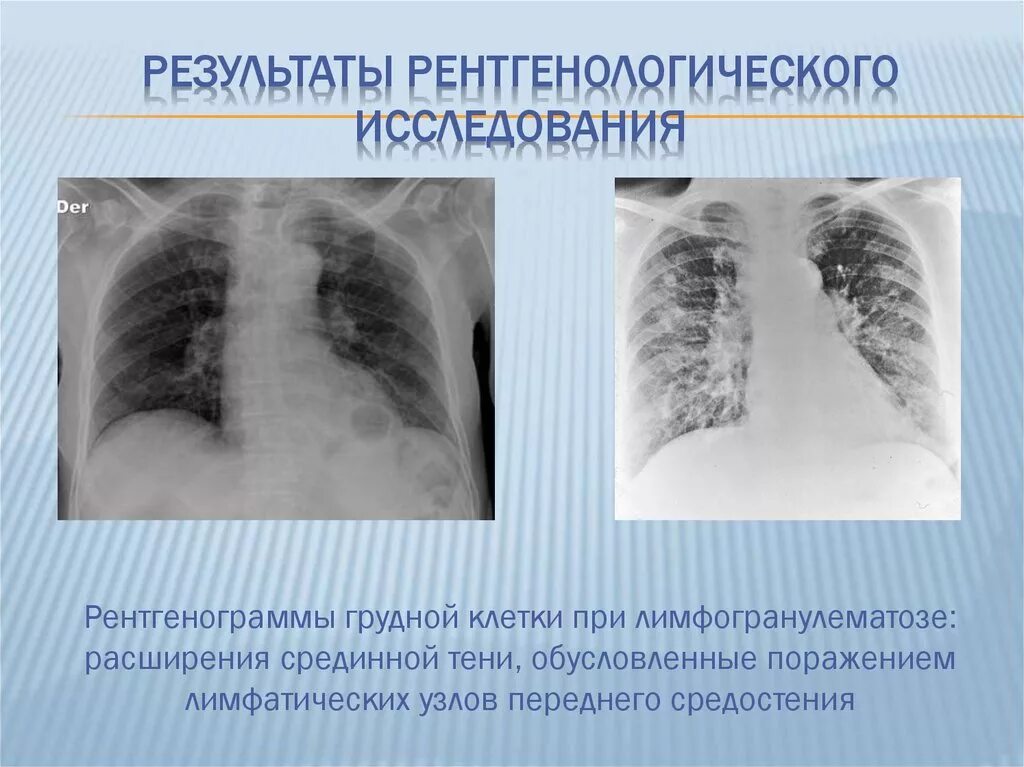 Легкие при коклюше. Лимфогранулематоз средостения рентген. Лимфогранулематоз легкого рентген. Лимфогранулематоз рентген легких. Лимфогранулематоз рентгенологическая картина легких.