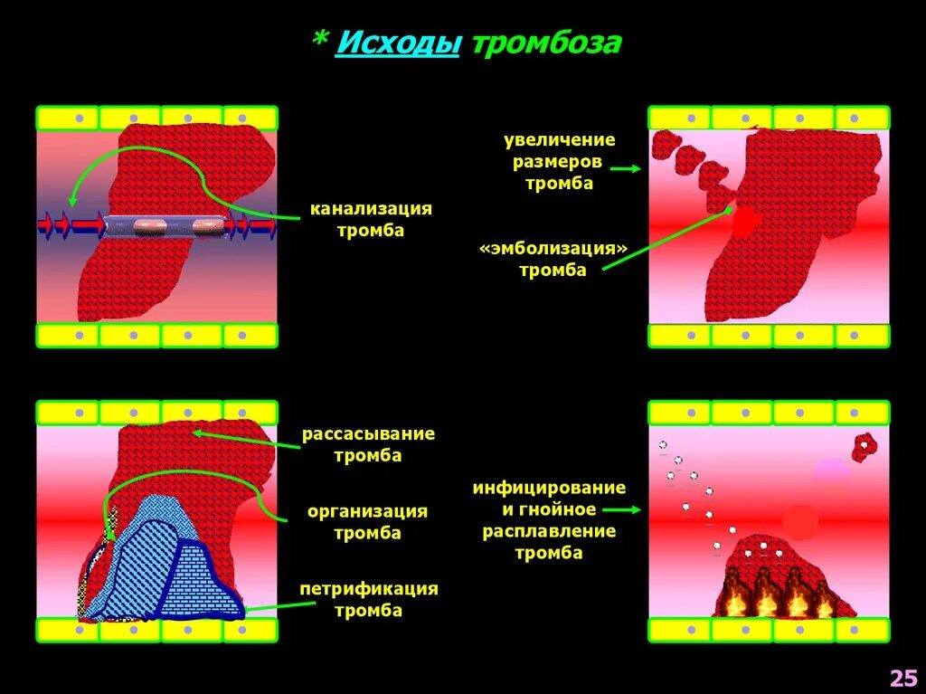 Исходы тромба. Исходы тромбоза. Организация тромба