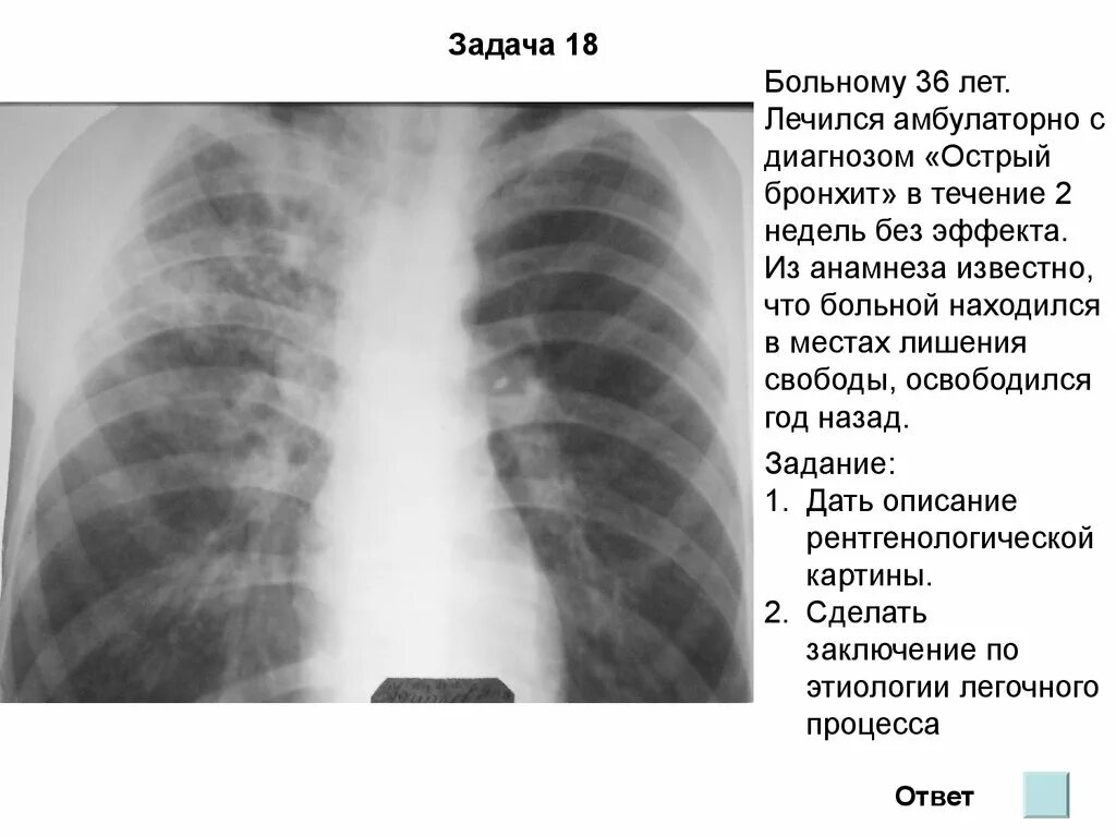 Задача бронхит. Острый бронхит снимок рентген. Острый обструктивный бронхит рентген. Хронический бронхит рентген. Бронхит на рентгене.