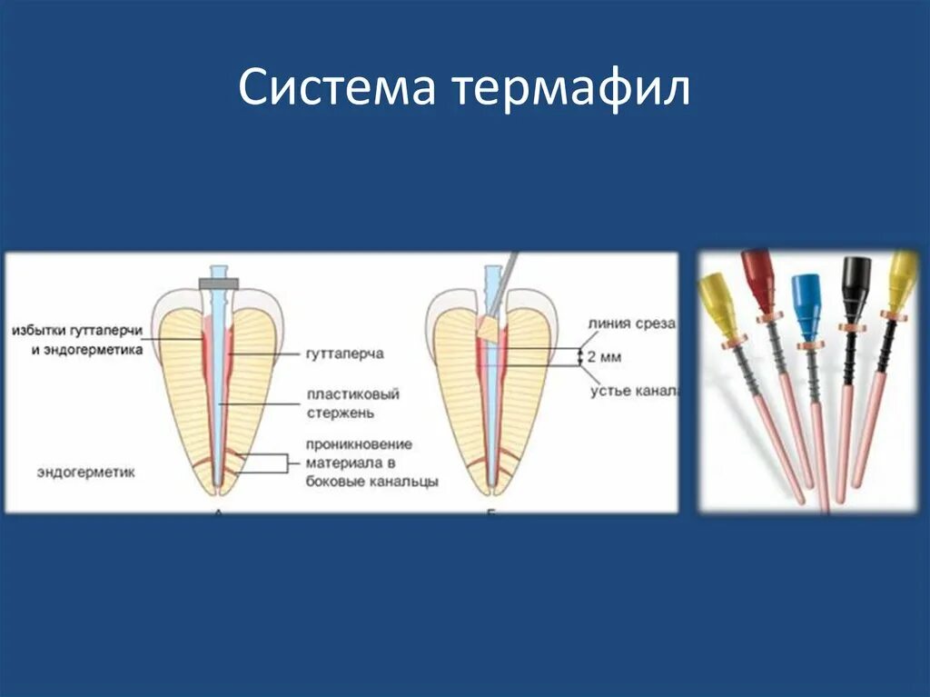 Обтурация корневых каналов системой "Термафил". Пломбировочная система корневых каналов «Термафил».. Термофил методика пломбирования. Термофил эндодонтия. Гуттаперч вый опрометч вость