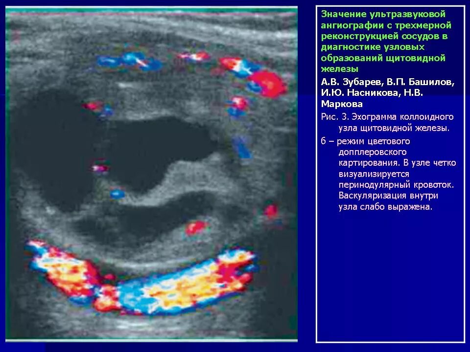 Перинодулярный кровоток что это. Коллоидные узлы щитовидной железы по УЗИ. Коллоидный узел щитовидной железы на УЗИ. Коллоидный узел щитовидной железы на УЗИ Изранов. Что такое коллоид в узле щитовидной железы.