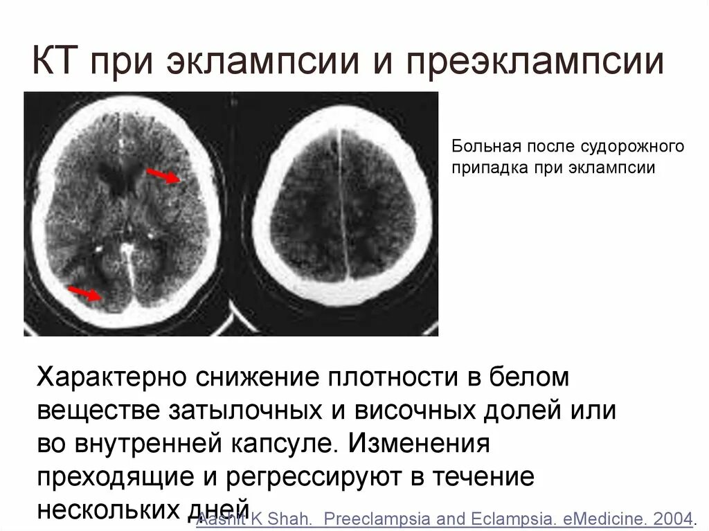 Диффузное снижение плотности. Снижение плотности белого вещества мозга кт. Перивентрикулярный лейкоареоз на кт. Отек белого вещества головного мозга кт. Кт головного мозга при эклампсии.