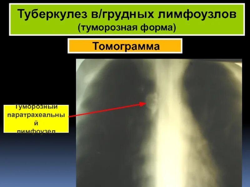 Туберкулез молочной. Туморозная форма туберкулеза внутригрудных лимфатических узлов. Туберкулез паратрахеальных лимфатических узлов. Туберкулез лимфатических узлов рентген. Туберкулёз грудных лимфоузлов.