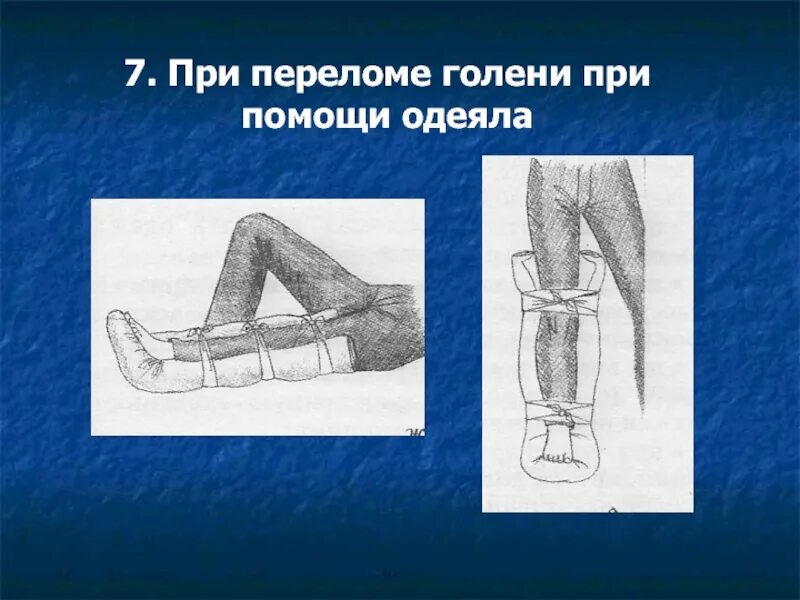 Перелом голени транспортировка. Иммобилизация при переломе голени. Иммобилизация нижней конечности. Транспортная иммобилизация при переломе голени.