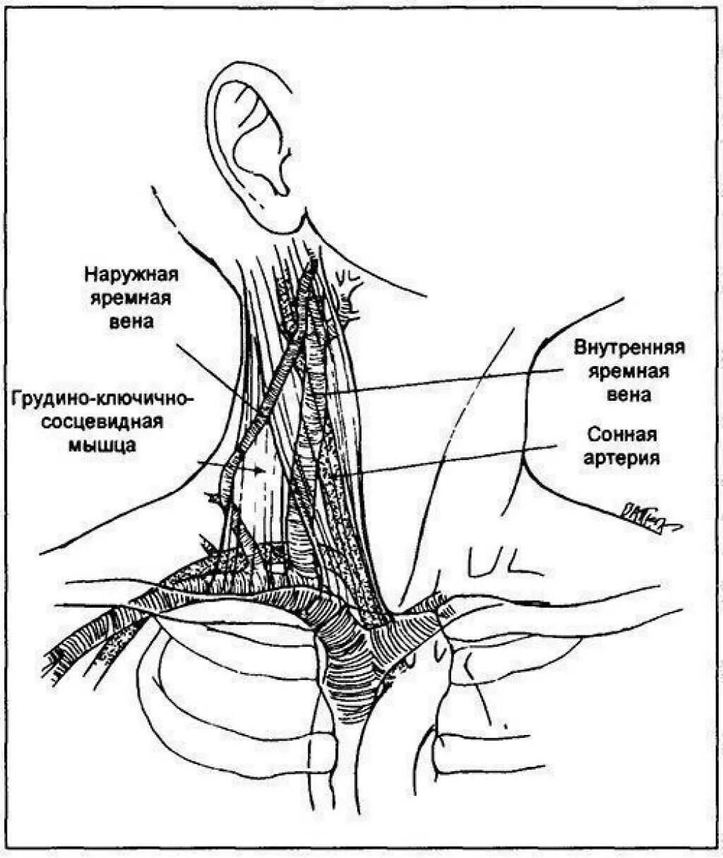 Расширение яремной вены. Наружная и внутренняя яремная Вена анатомия. Яремная Вена и артерия анатомия. Наружная яремная Вена передняя яремная Вена. Внутренняя яремная Вена анатомия катетеризация.