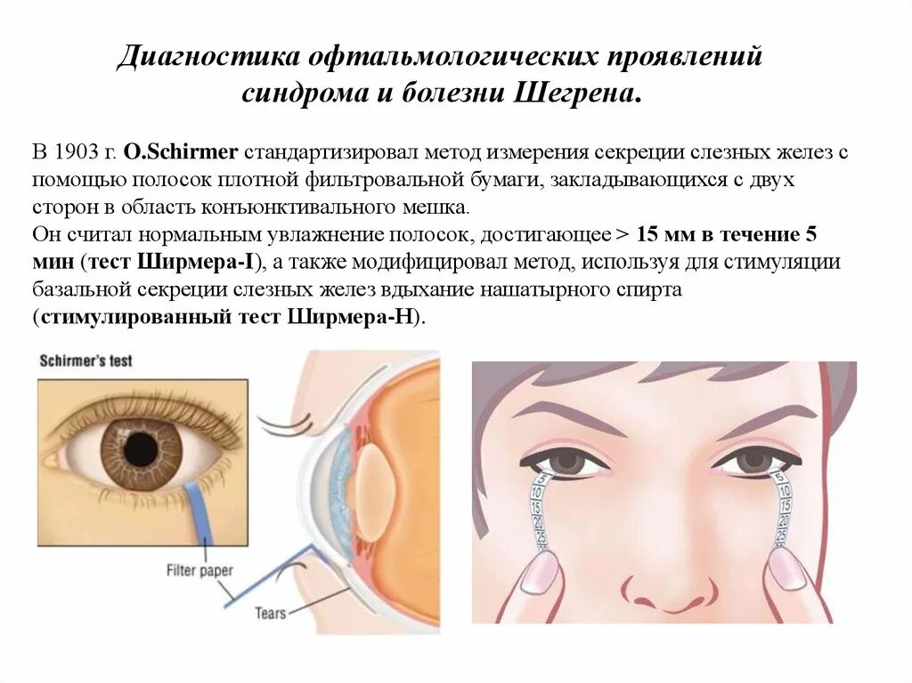 Синдром ашера в офтальмологии. Синдром шегрена диагностика. - выявление глазных симптомов.