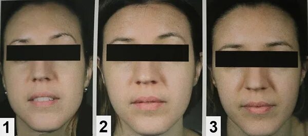 Ботулинотерапия жевательных мышц. Асимметрия жевательных мышц. уколы ботокса в жевательные мышцы. диспорт в жевательные мышцы. гипертонус жевательных мышц ботулинотерапия.