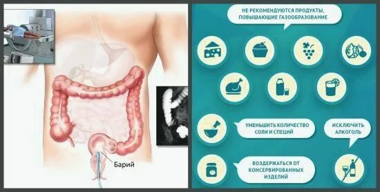 Что есть при колоноскопия кишечника. Обследования кишечника ирригоскопия. меню перед ирригоскопией кишечника. диета перед ирригоскопии. диета при колоноскопия кишечника.