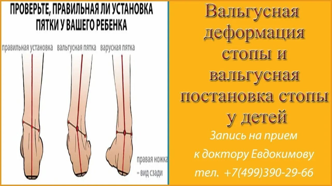 Вальгусное положение стопы. Варусная постановка стопы у ребенка. вальгусная деформация стопы. правильная постановка стопы. вальгусная деформ ац ятоп.