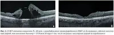 Сквозной макулярный разрыв сетчатки операция. Макулярный разрыв окт. Макулярный разрыв сквозной с крышечкой 342мкм что такое. Операция при макулярном разрыве. Макулярный разрыв после операции