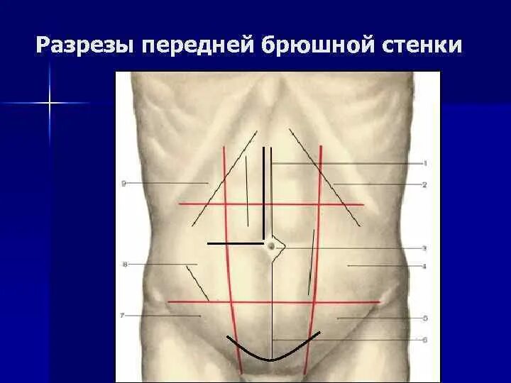 Толстая брюшная стенка. Топографические линии брюшной стенки. Отделы передней брюшной стенки топографическая анатомия. Топографические области передней брюшной стенки. Топография передней брюшной стенки.