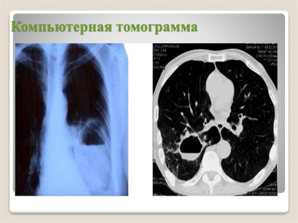 Поствоспалительные изменения в легких на кт. Посттуберкулезные изменения на кт. посттуберкулезные изменения в легких на кт. пневмосклероз на кт легких. посттуберкулёзные изменения в лёгких на кт.