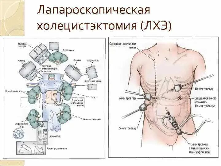 Лапароскопия показания. Этапы операции холецистэктомии лапароскопической. Холецистэктомия желчного пузыря лапароскопическая. Лапароскопическая холецистэктомия протокол. Расстановка портов при лапароскопической холецистэктомии.