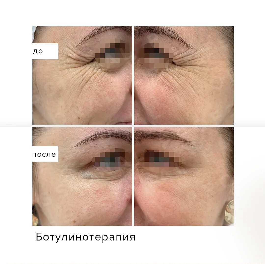 Ботулинотерапия результаты. Ботулинотерапия результаты