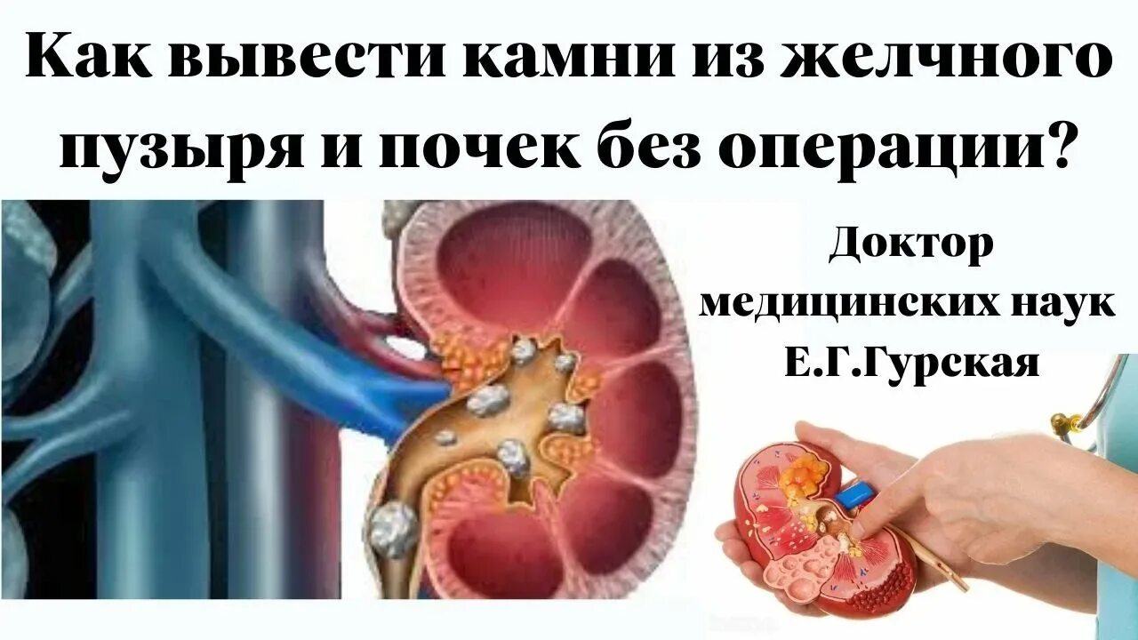 Камни в желчном пузыре в почках. Камни в почках и желчном пузыре. как выважить камней из почек. камни в жёлчном пузыре операция.