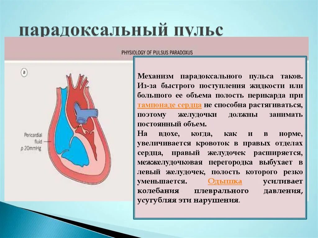 Парадоксальный пульс это