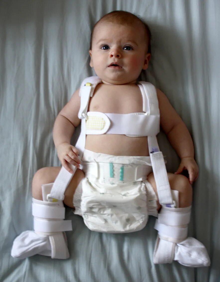 вылечили дисплазию тазобедренных суставов