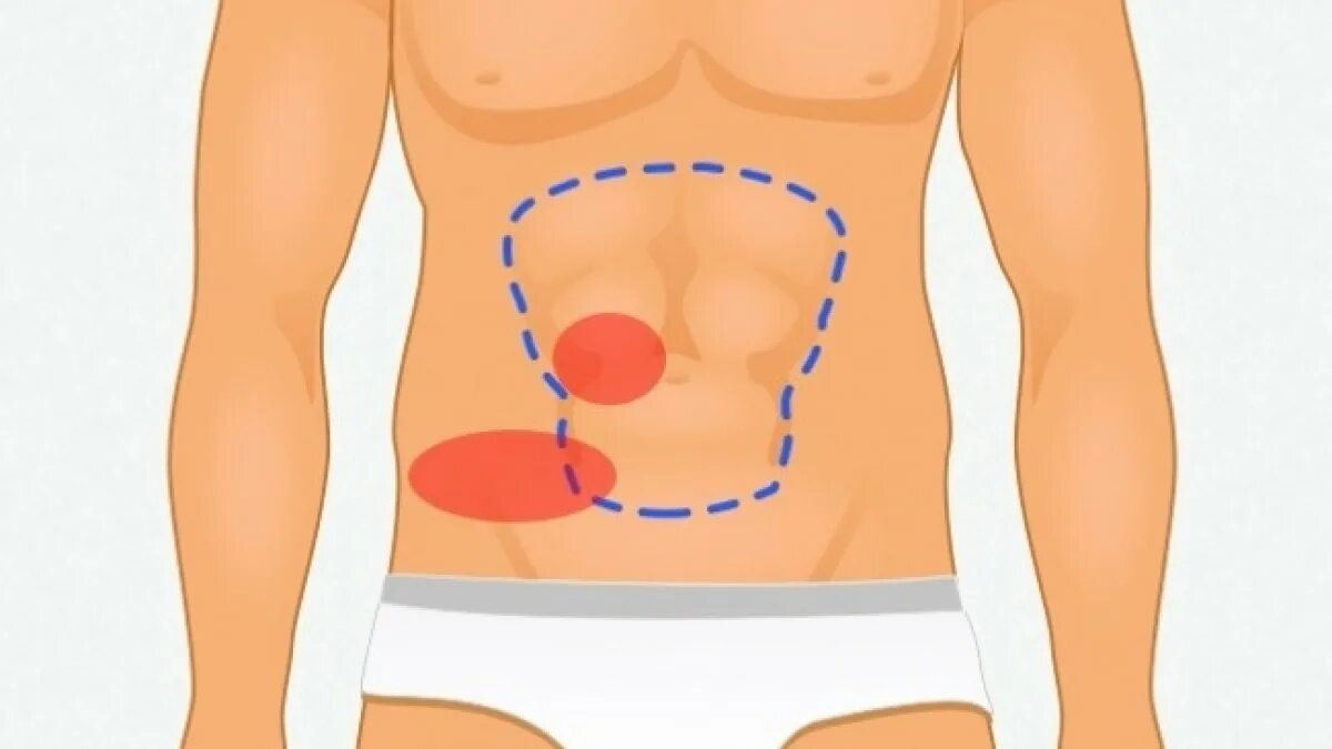 Аппендикс находится справа или слева. Дискомфорт в области живота. Болит вокруг живота. Болит у пупка справа. Слева от пупка.