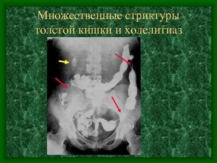 Стриктура ободочной кишки. Стриктура толстой кишки. Стриктуры тонкого кишечника. Стриктура подвздошной кишки.