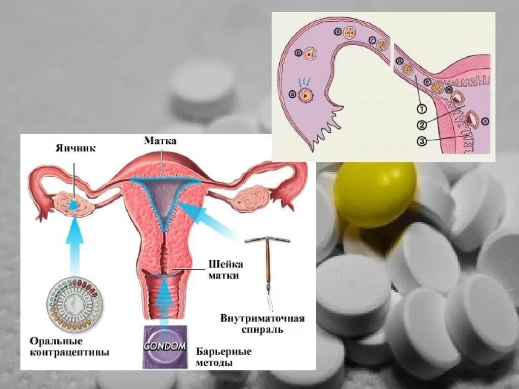 Гормональная контрацепция. Процесс овуляции. Таблетки чтобы не забеременеть. Оральные и внутриматочные контрацептивы. Овуляция после приема
