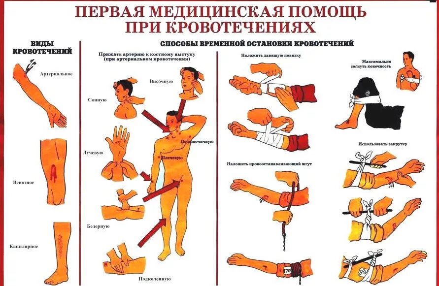 Правила оказания первой при кровотечении. Памятка ПМП при артериальном кровотечении. Способы временной остановки артериального кровотечения ПМП. Виды РАН, виды кровотечения и способы остановки кровотечения. Кровотечения и правила оказания первой помощи при кровотечениях..