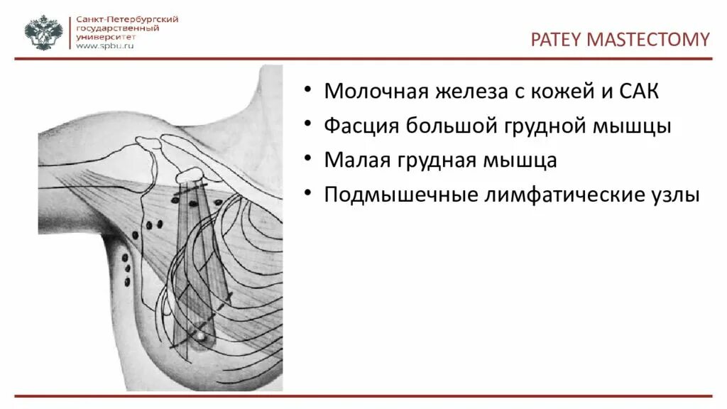 Сторожевой лимфатический узел молочной железы. Сторожевые лимфоузлы молочной железы. Лимфоузлы малой грудной мышцы. Увеличен лимфоузел в молочной железе