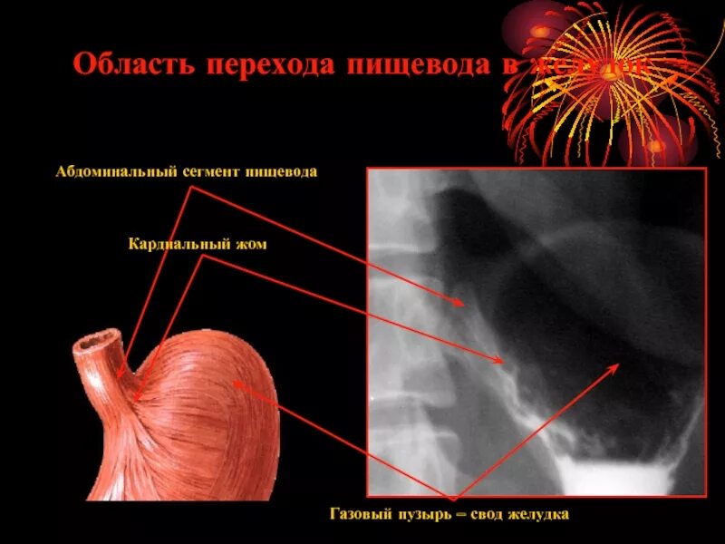 Кардиальный отдел пищевода. Кардиальный жом желудка. Кардиальный жом пищевода. Недостаточность кардиального сфинктера. Недостаточность кардиального жома.