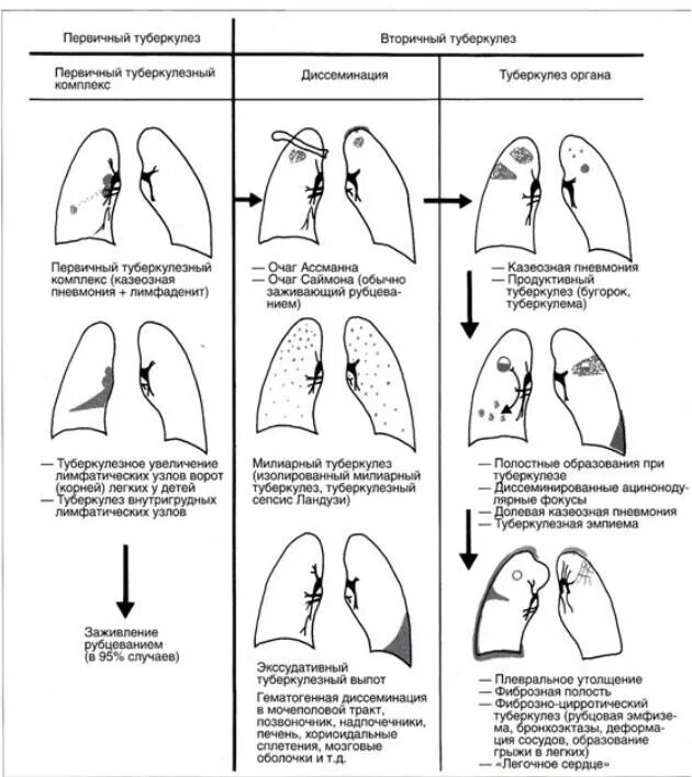 Неактивный туберкулез. Клинические формы туберкулеза легких схемы. Классификация форм туберкулеза легких схема. Туберкулез легких формы схемы. Формы легочного туберкулеза легких.