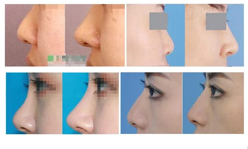 Ринопластика горбинки носа. Нос до и после ринопластики с горбинкой. Нос до и после ринопластики с горбинкой. Нос до и после ринопластики с горбинкой. Ринопластика горбинки носа.