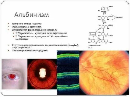 Альбинизм сетчатки