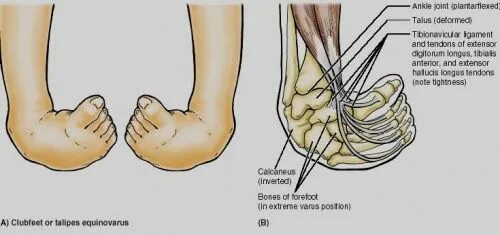 Эквинус стопы. Эквинус стопы. Эквинусная деформация стопы. Врожденная косолапость симптомы. Супинация косолапости.