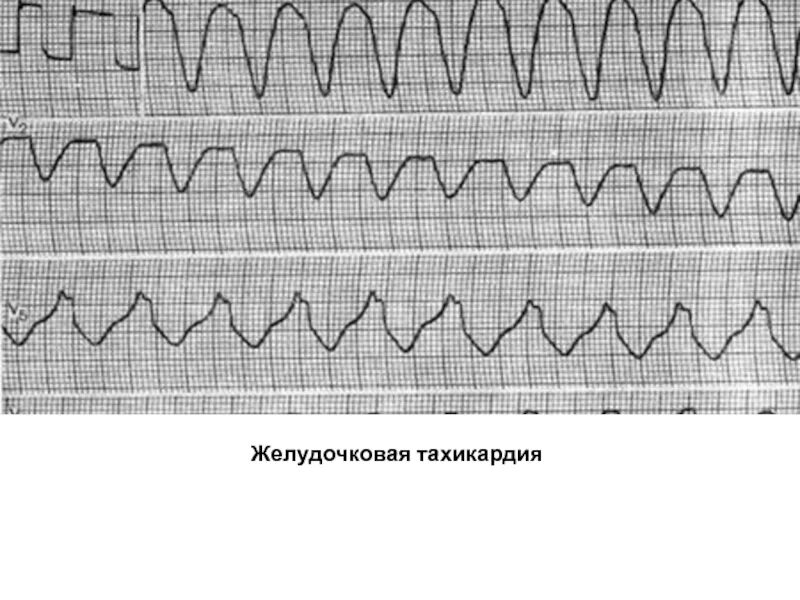 Желудочковая тахикардия на экг. Пароксизмальная желудочковая тахикардия на ЭКГ. ЭКГ желудочковая тахикардия ЭКГ. Вентрикулярная пароксизмальная тахикардия ЭКГ.