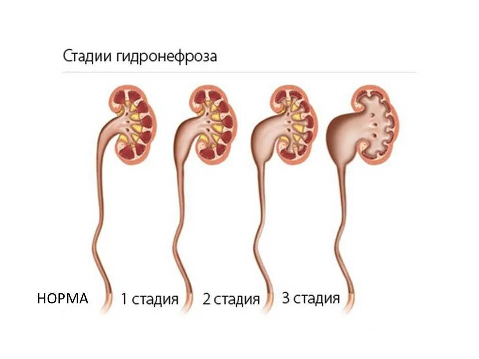 Почки лоханка причины. Гидронефроз почки 3 стадии. Строение почки гидронефроз. Гидронефроз 2-3 степени.