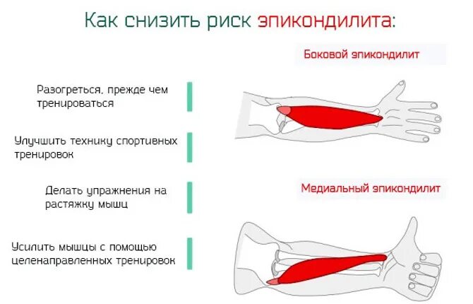 Почему болят локтевые сгибы. Эпикондилит локтевого симптомы. Медиальный эпикондилит упражнения. Эпикондилит локтевого упражнения. Эпикондилит локтевого сустава ЛФК.