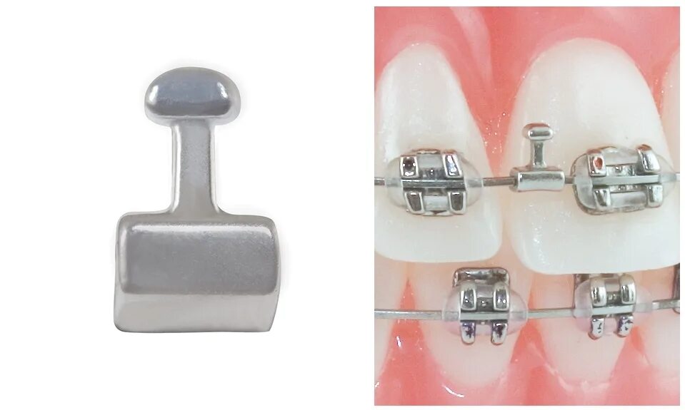 Эластики американ ортодонтикс. Крючки для брекетов damon 3mx и q (242-0114). Стопор зажимной ортодонтическая. Брекеты с замочками металлические. Кросс эластик ортодонтия.